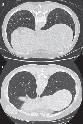 Interstitial lung abnormalities in patients with early rheumatoid arthritis: A pilot study evaluating prevalence and progression