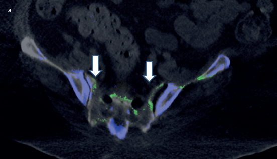 Lower back pain as a manifestation of acute gouty sacroiliitis: Utilization of dual-energy computed tomography (DECT) in establishing a diagnosis