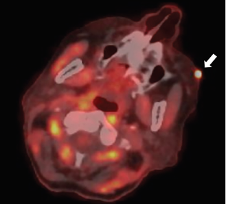 Nuclear medicine imaging in idiopathic inflammatory myopathies