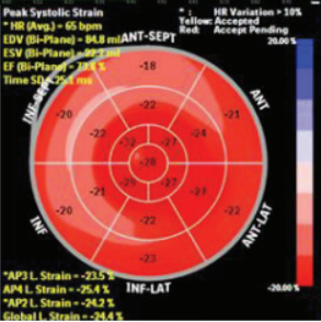 Evaluation of subclinical myocardial dysfunction using speckle tracking echocardiography in patients with radiographic and non-radiographic axial spondyloarthritis