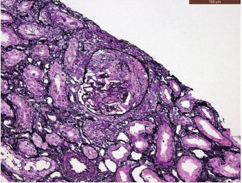 Granulomatosis with polyangiitis with breast involvement mimicking metastatic cancer: Case report and literature review