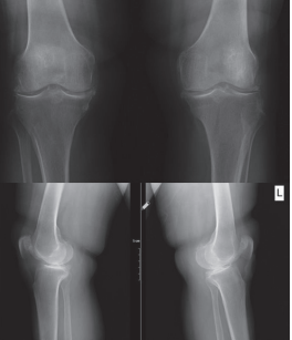 Two cases of calcium pyrophosphate deposition disease (CPPD) presented with spondylodiscitis