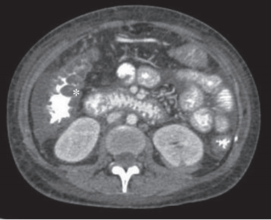 Lupus with “thumb-prints,” “targets,” and “combs”