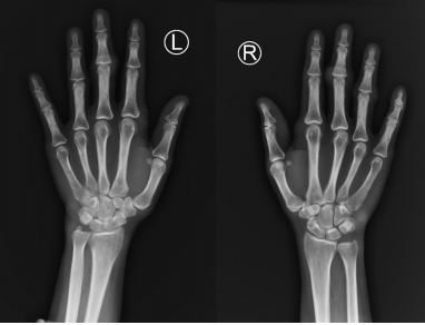 Hypercholesterolemic arthritis in a young female