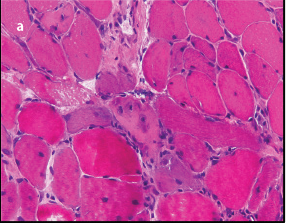 A case of statin-associated immune-mediated necrotizing myopathy with atypical biopsy features
