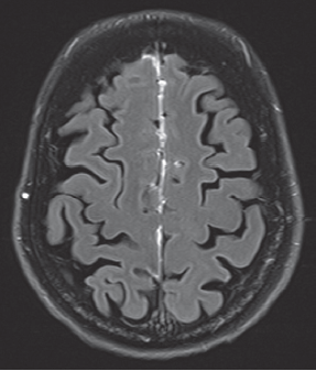 Leptomeningitis in rheumatoid arthritis