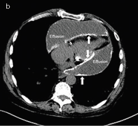 Effusive constrictive pericarditis in systemic sclerosis